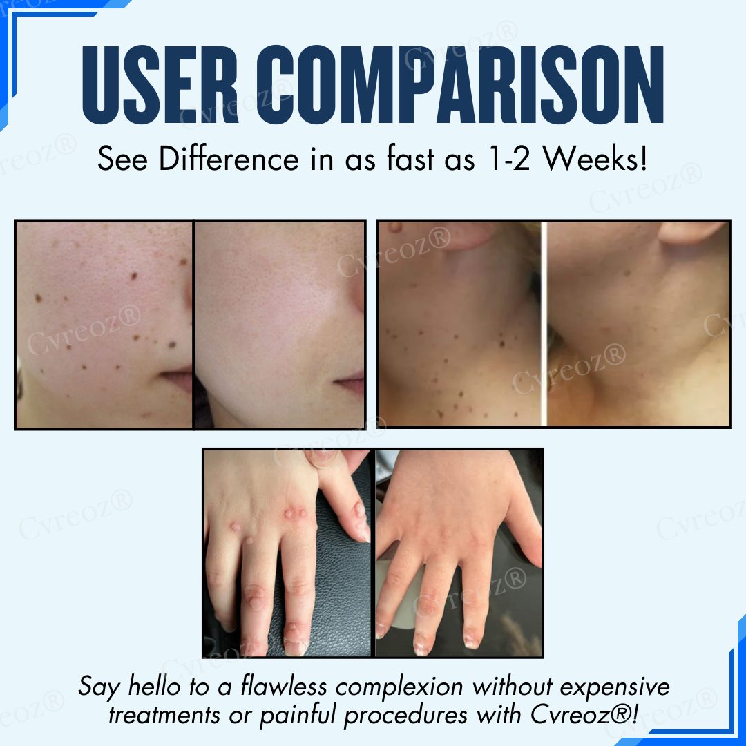 Cvreoz® Moles & Warts Removing Skin Tag Patch