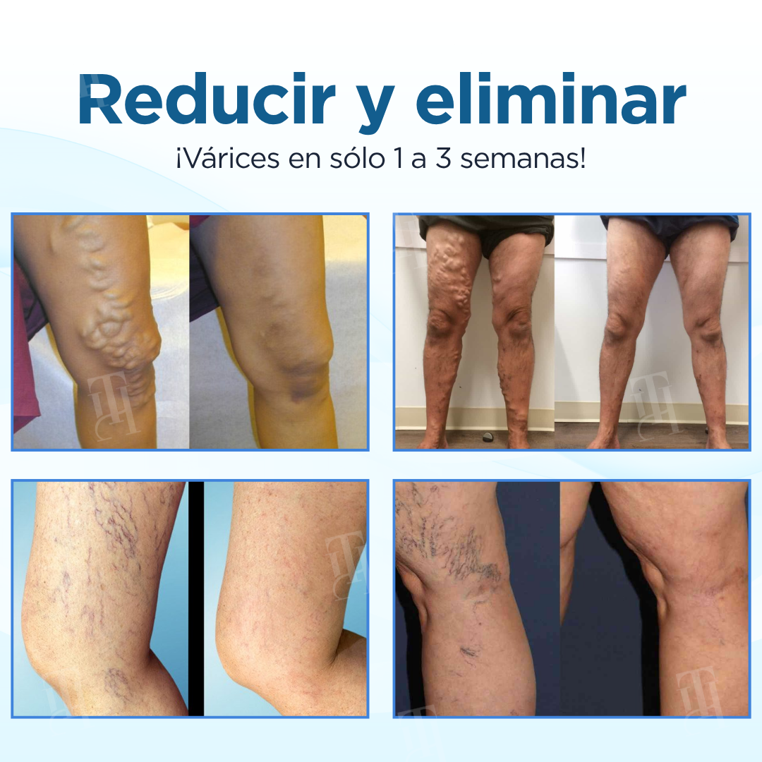 Cvreoz® Hierbas Varices Tratamiento Spray