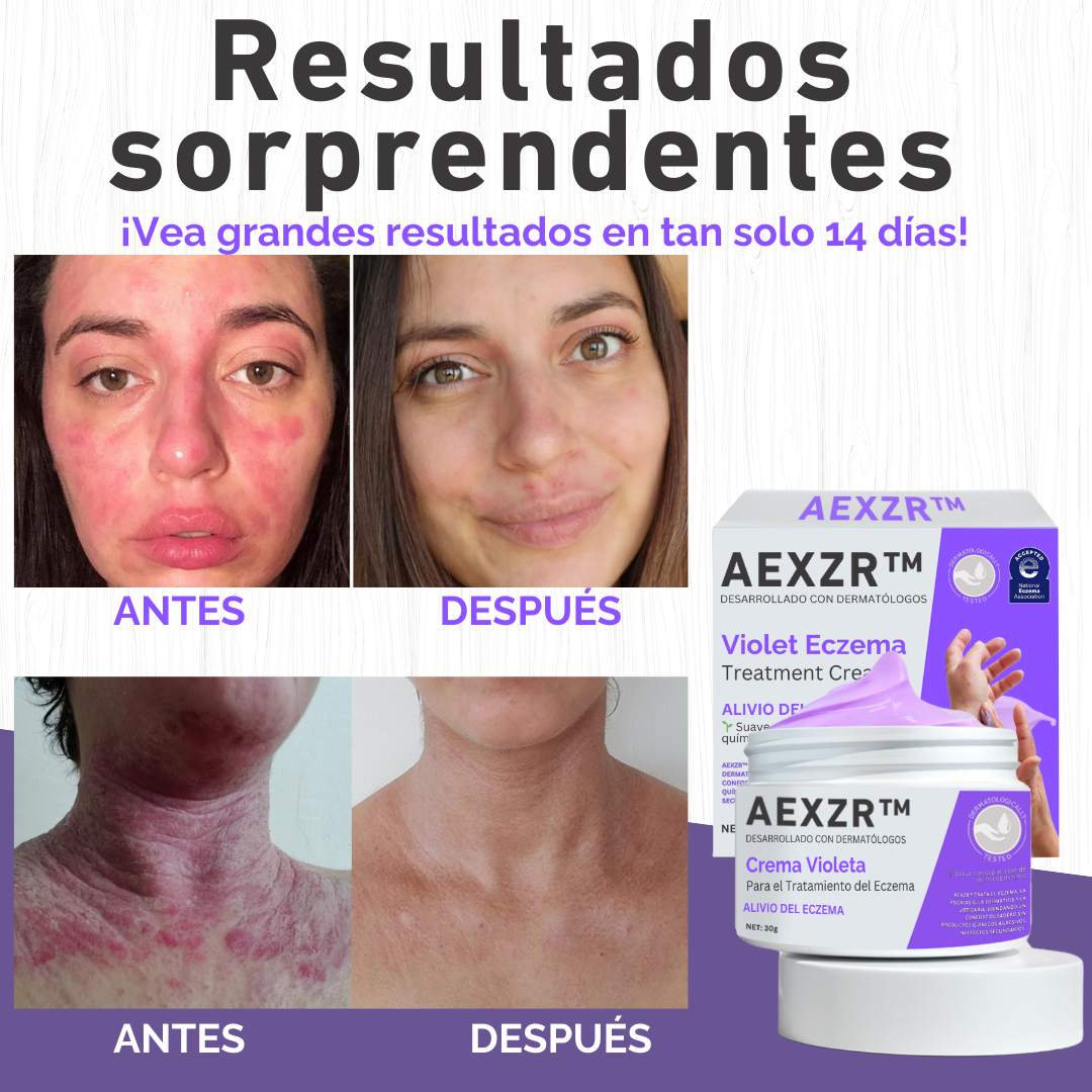 AEXZR™ Crema Violeta para el Tratamiento del Eczema