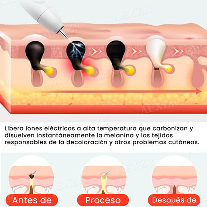 Hudfil™ Láser Portátil de Cuidado de la Piel