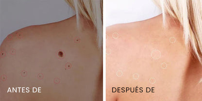 Hudfil™ Láser Portátil de Cuidado de la Piel
