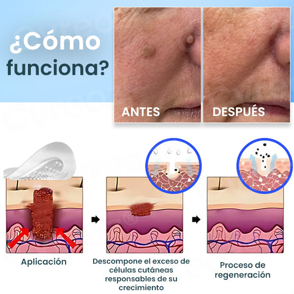 Cvreoz® Parches Eliminadores De Nano-micro-Agujas
