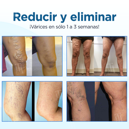 Cvreoz® Hierbas Varices Tratamiento Spray